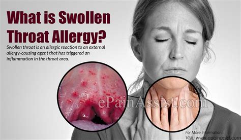 What Is Swollen Throat Allergy And How Is It Treated