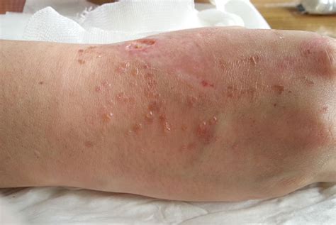 Skin Reactions To Wound Dressings Gponline