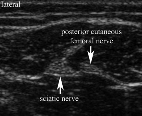 Transverse View Of The Sciatic Nerve And The Posterior Cutaneous