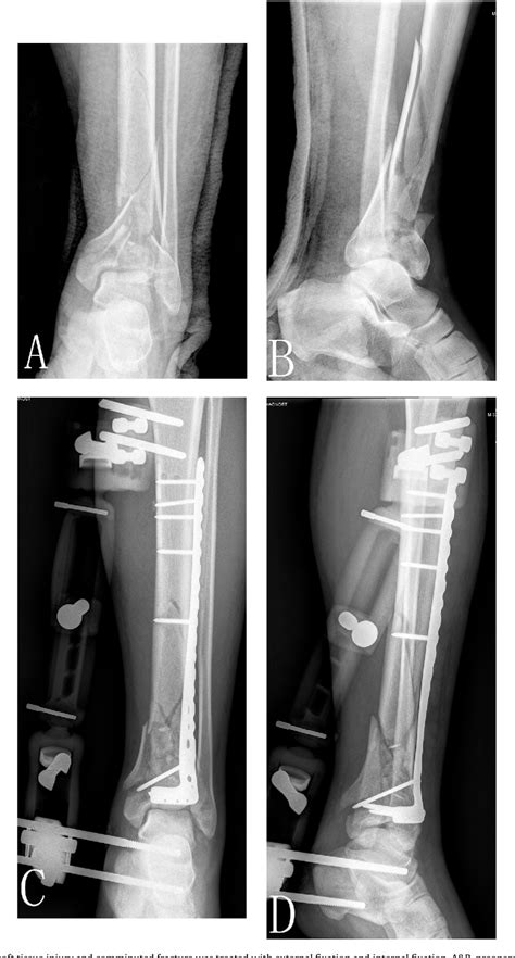 Figure 1 From Injury Mechanism Fracture Characteristics And Clinical