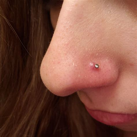 Keloid Help Picture Two For Reference If Sensitive Dont Look Rnosepiercing