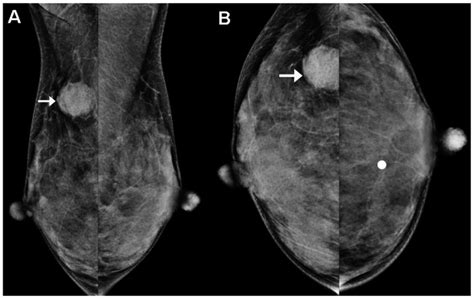 Mammogram On The A Mediolateral Oblique And B Craniocaudal View