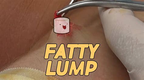 Forearm Lipoma Quickie Little Fatty Lump Excision Youtube