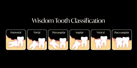 Wisdom Tooth Extraction Melbourne Dr Jaclyn Wong