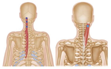 Some common symptoms of cervical osteoarthritis can include one or more of the following Trigger Point Therapy - Neck Arthritis (Cervical ...