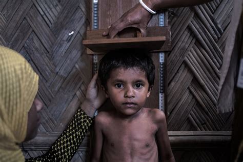 Irin Malnutrition Stalks Rohingya Refugees In Bangladesh