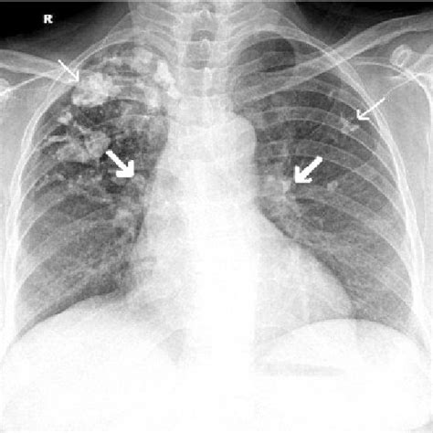 Chest Radiograph Postero Anterior View Showing Coarse Calcifications