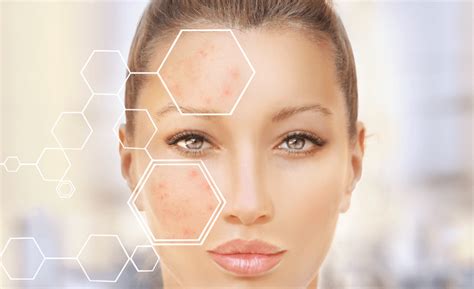 This type of scar can show up as broad rolling depressions. How to treat acne scars - Skin MD Boston Med Spa