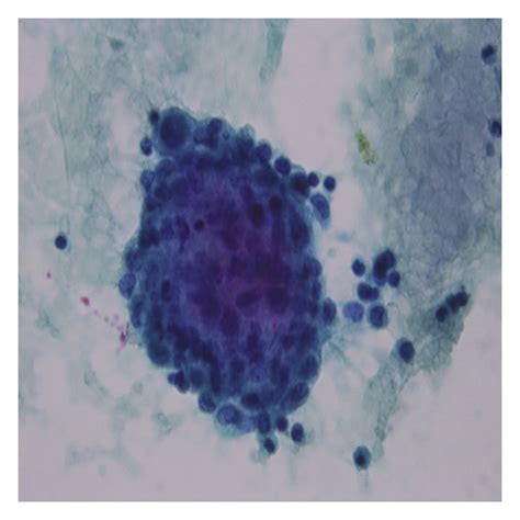 Pleural Fluid Cytology Pap Stain ×40 Mesothelial Cells With