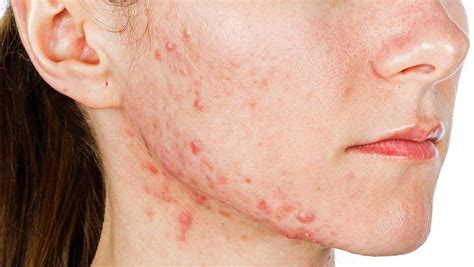 Fda Approves First Topical Minocycline Formulation For Acne Vulgaris Mpr