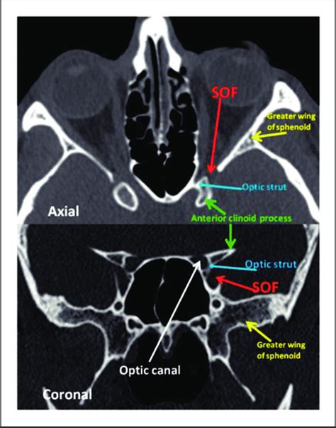 Orbital Apex Anatomy Ct Axial And Coronal Ct Slices Demonstrate The