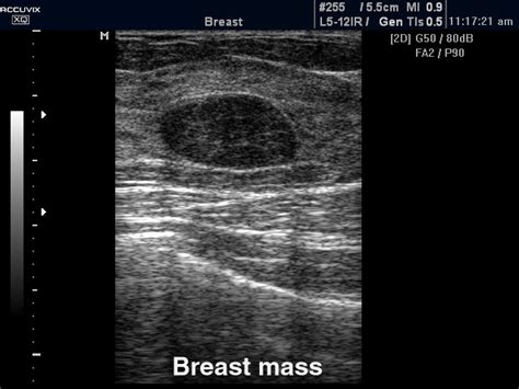 Breast Ultrasound Ultrasound Guided Biopsy