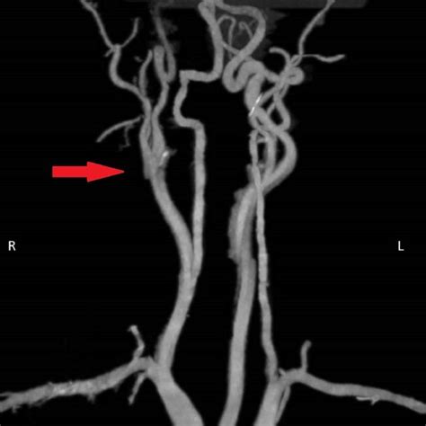 Ct Angiogram Demonstrating Severe Attenuation Of Right Internal Carotid