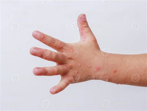 Hand Foot And Mouth Disease Hfmd Human Hand Of Scarlet Fever On Palm