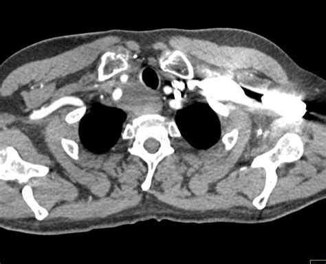 Esophageal Cancer With Supraclavicular And Abdominal Adenopathy