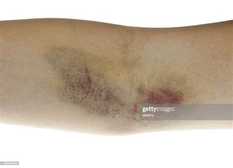 Hematoma High Res Stock Photo Getty Images