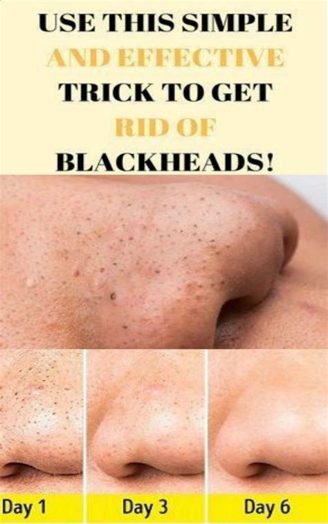 Use This Simple And Effective Trick And Get Rid Of Blackheads Get