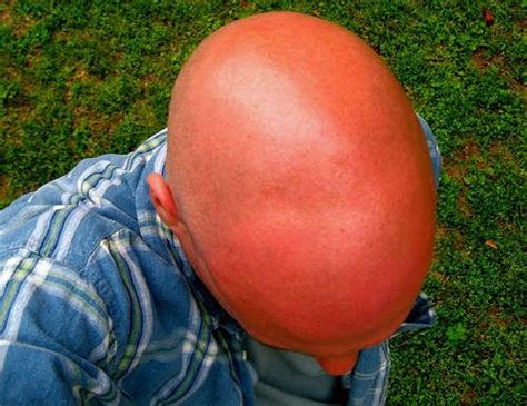 Picture Gallery Most Extreme Sunburns Going Bald Hair Loss Bald Heads