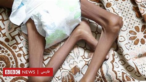 دو میلیون کودک، دست به گریبان با وبا و سوء تغذیه؛ حاصل بیش از سه سال