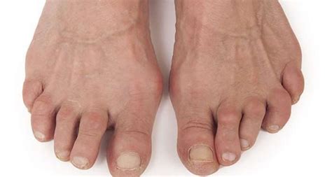 Rheumatoid Arthritis The Foot Care Group