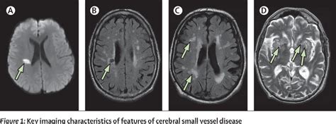 Small Vessel Disease Brain Mri Slide Share