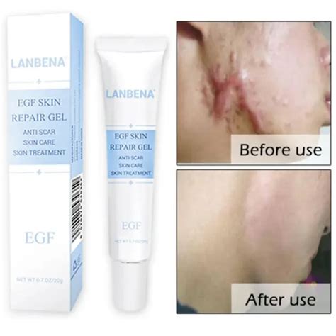 Buy 20g Acne Scar Remove Cream Treatment Stretch Mark