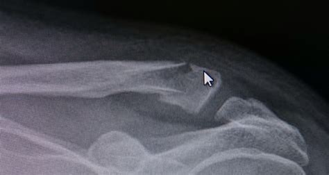 Broken Clavicle An Overview The Putney Clinic Of Physical Therapy