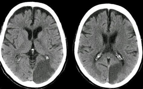 Dr Balaji Anvekar Frcr Ischemic Stroke And Vascular Territories Of Brain