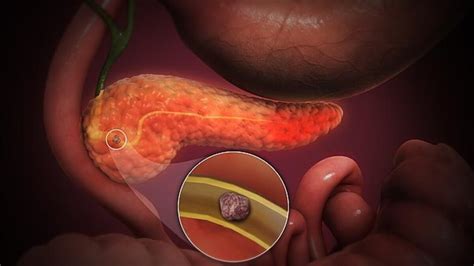 Pancreatitis Aguda ¿por Qué Es Importante Controlar Sus Síntomas Antes
