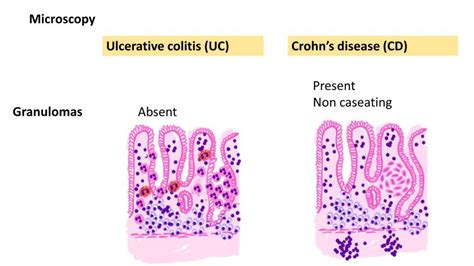 Pathology Of Ulcerative Colitis Pathology Made Simple