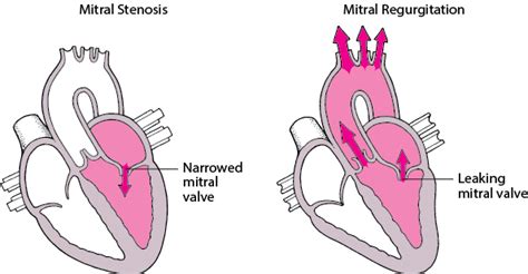 Overview Of Heart Valve Disorders Heart And Blood Vessel Disorders
