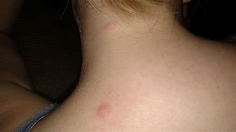 Mosquito Bites And Swollen Lymph Nodes Babycenter