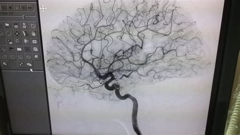 Cerebral Angiography Youtube