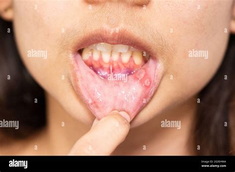 Close Up Asian Woman Have Aphthous Ulcer Or Canker Sore On Mouth At Lip Stock Photo Alamy