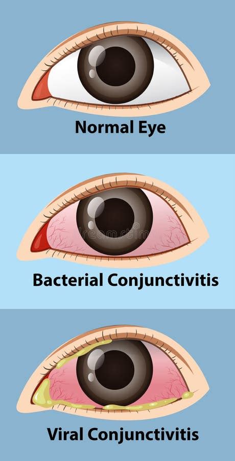 Different Stages Of Conjunctivitis In Human Eye Stock Vector