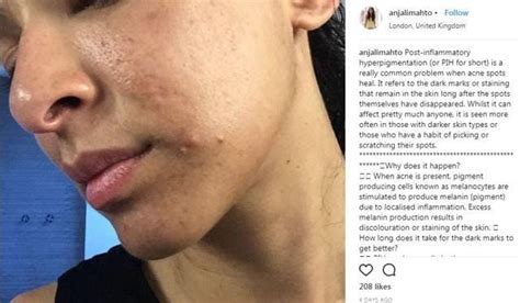 Skin Positivity The Biggest Beauty Trend Of 2018 Has People Posting