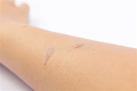 Blisters On Skin Arm Stock Image Image Of Sore Acid 77907859