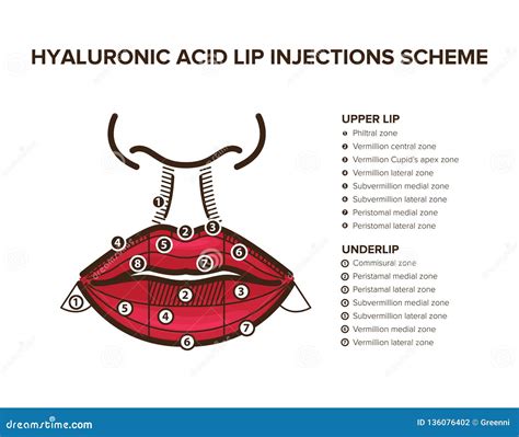 Hyaluronic Acid Filler Lip Injections Lip Anatomy Vector Illustration