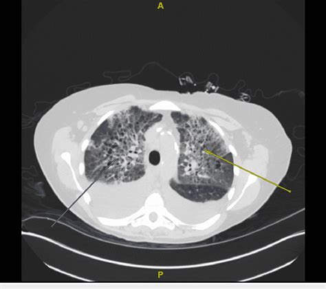 Axial Section From A Non Contrast Ct Chest Showing Large Bilateral