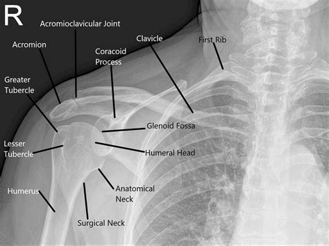 Anatomy Xray Of The Shoulder Joint Learn More About Structural Anatomy