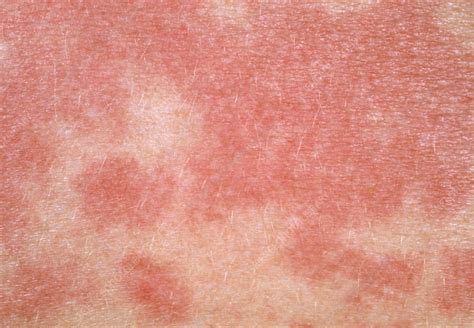 Rash On The Arm Due To A Food Allergy Stock Image M3200249