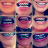 Images of Orthodontics In Progress