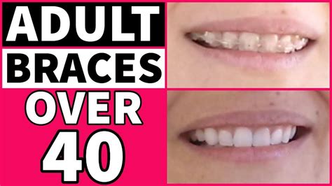 Adult Braces After 40 My Experience Youtube