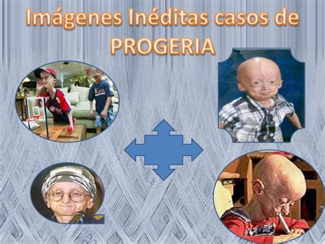 Vejez Infantil Progeria