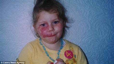 Woman Who Had Been Hiding Facial Birthmark For Years Finds Courage To