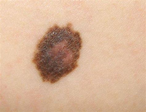 Apps To Identify Melanoma From Photos Often Inaccurate Study Says