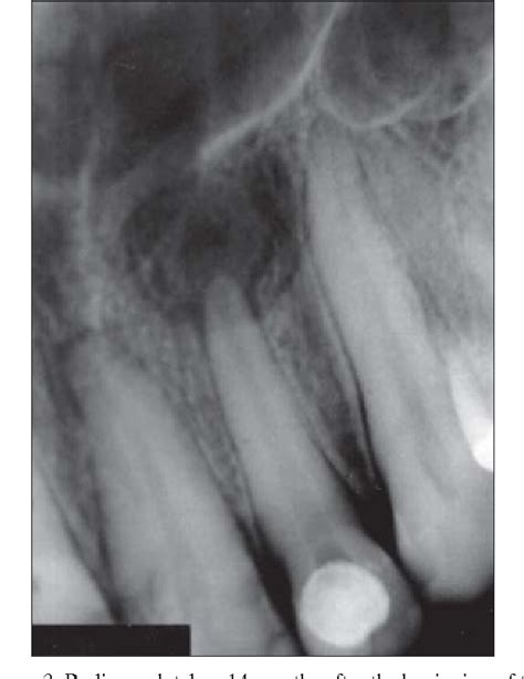 Figure 1 From Periapical Cyst Repair After Nonsurgical Endodontic