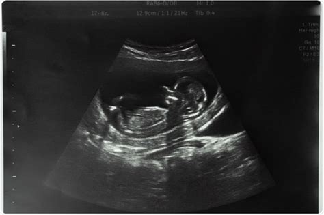 21 Weeks Pregnant Ultrasound Gender