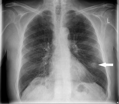 Investigating The Solitary Pulmonary Nodule The Bmj