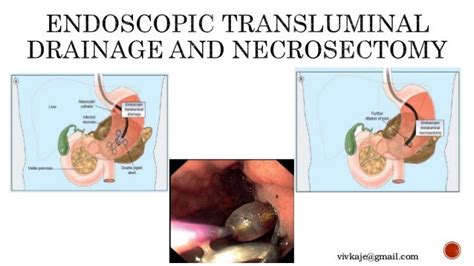 Minimally Invasive Necrosectomy